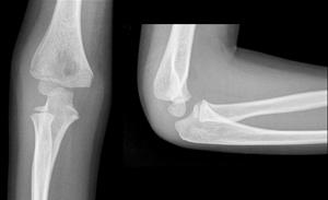 Figure 4A_0953789 Lateral condyle delayed union 1.jpg